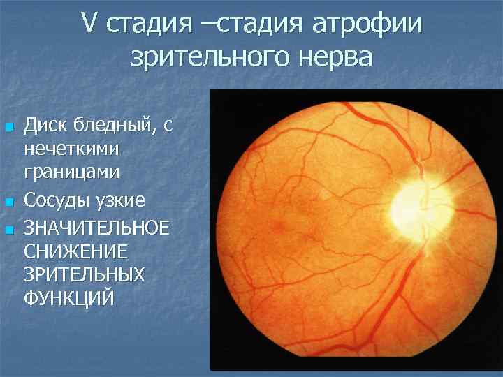 Симптомы и лечение отека диска зрительного нерва