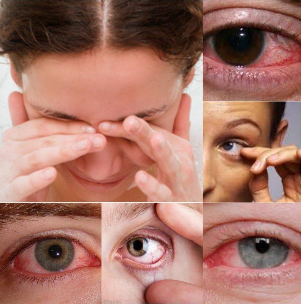 Усталость глаз - симптомы, причины и лечение