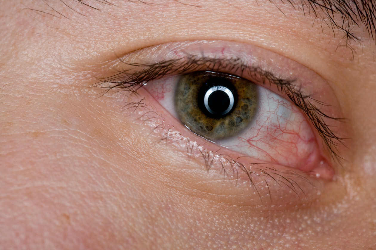 Рак глаза первые симптомы и признаки болезни