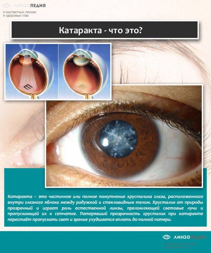 Врожденная катаракта