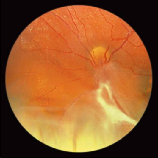 Лечение ретиношизиса