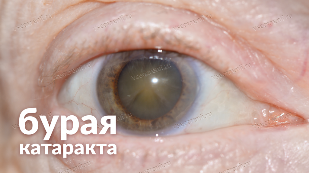 Ядерная катаракта: причины, симптомы, лечение, что это такое, болезнь у пожилых людей, профилактика