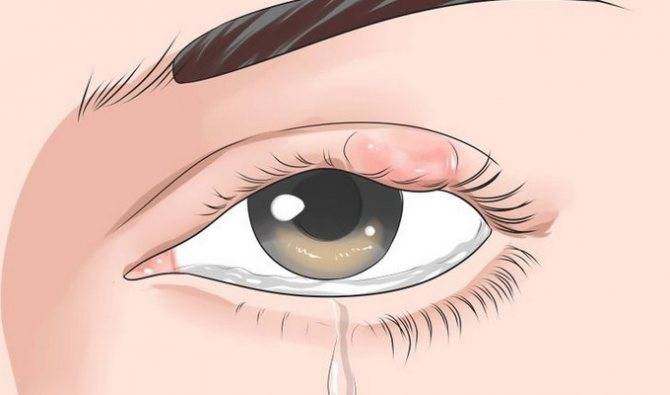 Халязион век у ребенка: лечение холязионов на глазу, как правильно лечить по доктору комаровскому