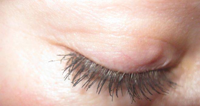 Шишка на веке глаза: причины появления уплотнения, симптомы нароста и лечение ячменя