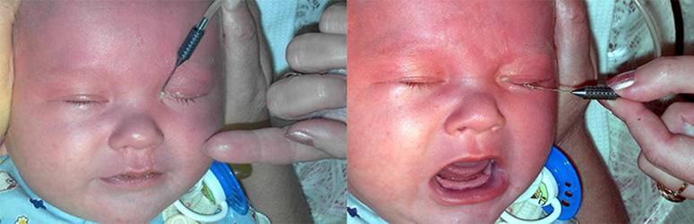 Ззондирование слезного канала у новорожденных - как делают