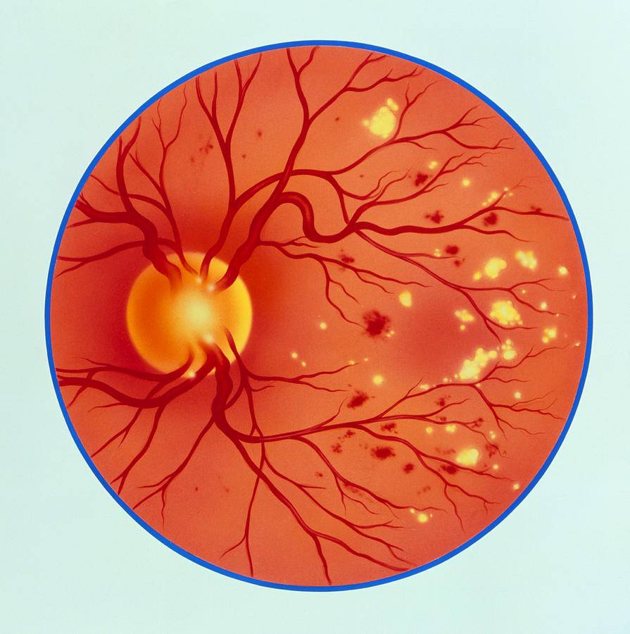 Диабетическая ретинопатия: симптомы, лечение, профилактика
