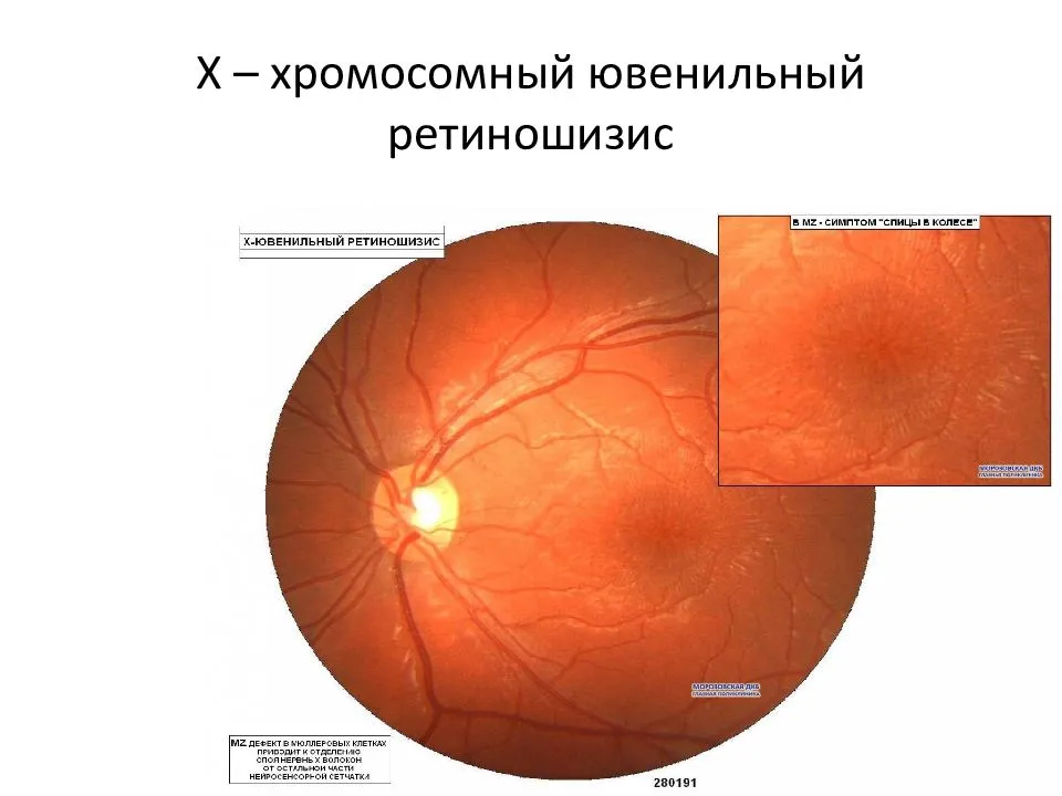 Ретиношизис или расслоение сетчатки глаза - что это такое, причины, симптомы и лечение патологии, прогноз сохранения зрения