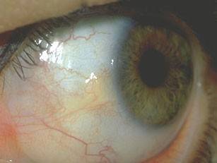Пингвекула глаза: причины возникновения у взрослых и методы лечения
