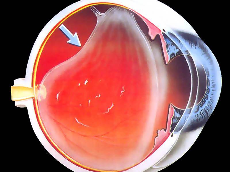 Отслойка стекловидного тела глаза: симптомы и лечение