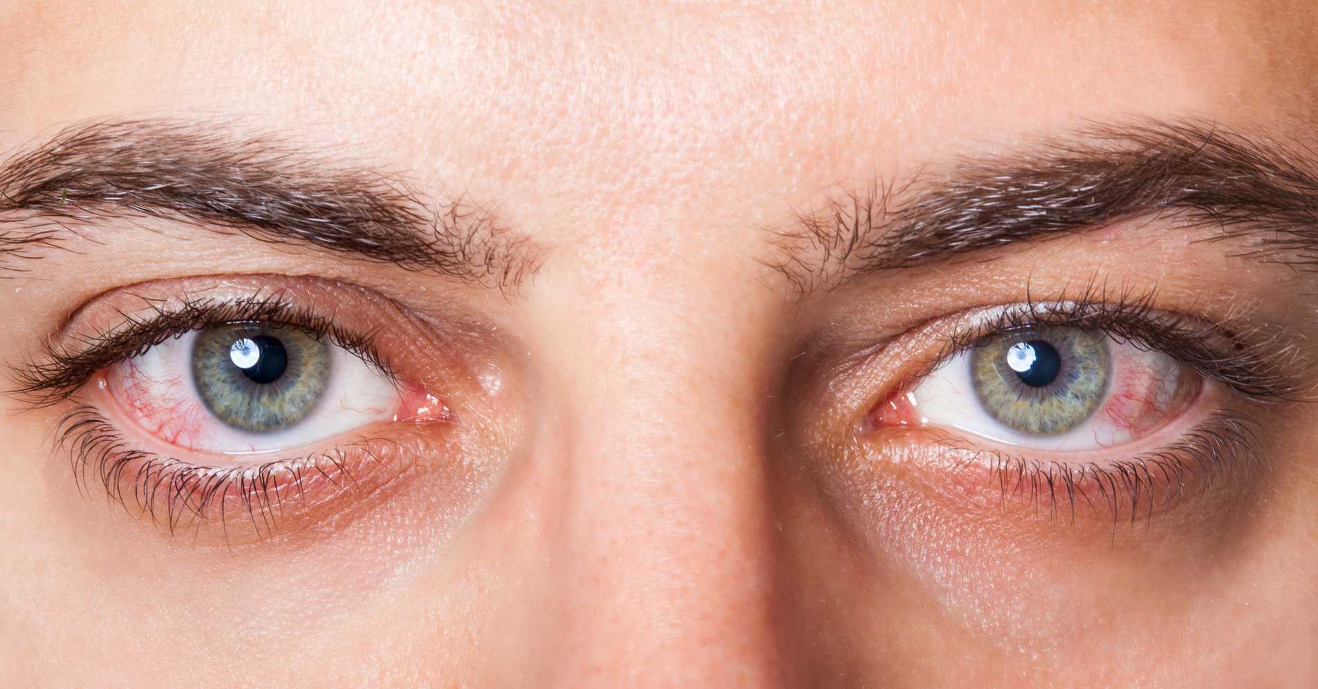 Что делать если глаза красные и болят от линз