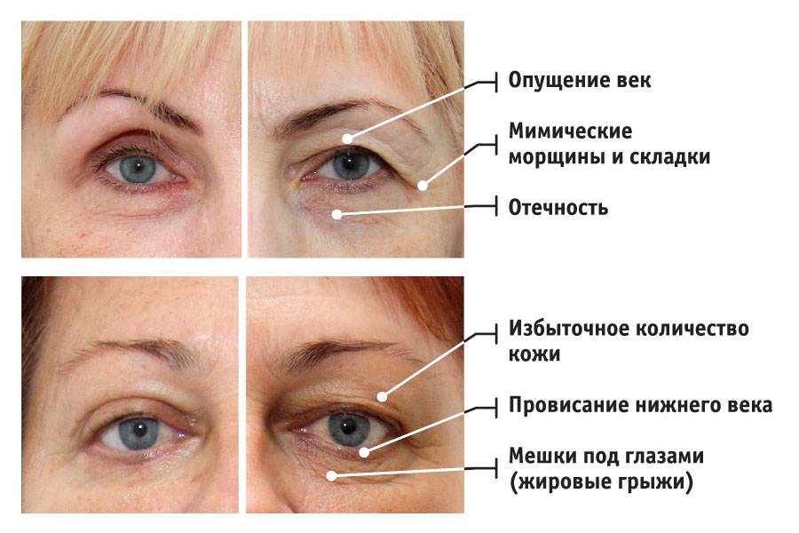 Записать веко. Опускание Нижнего века. Птоз века после блефаропластики верхнего века. Возрастной птоз верхнего века.