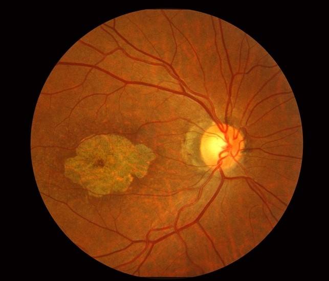 Разрывы и истончения сетчатки глаза: симптомы, причины и лечение