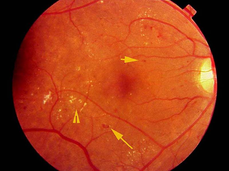 Ангиопатия (вазопатия, ангионевроз) сосудов сетчатки глаза