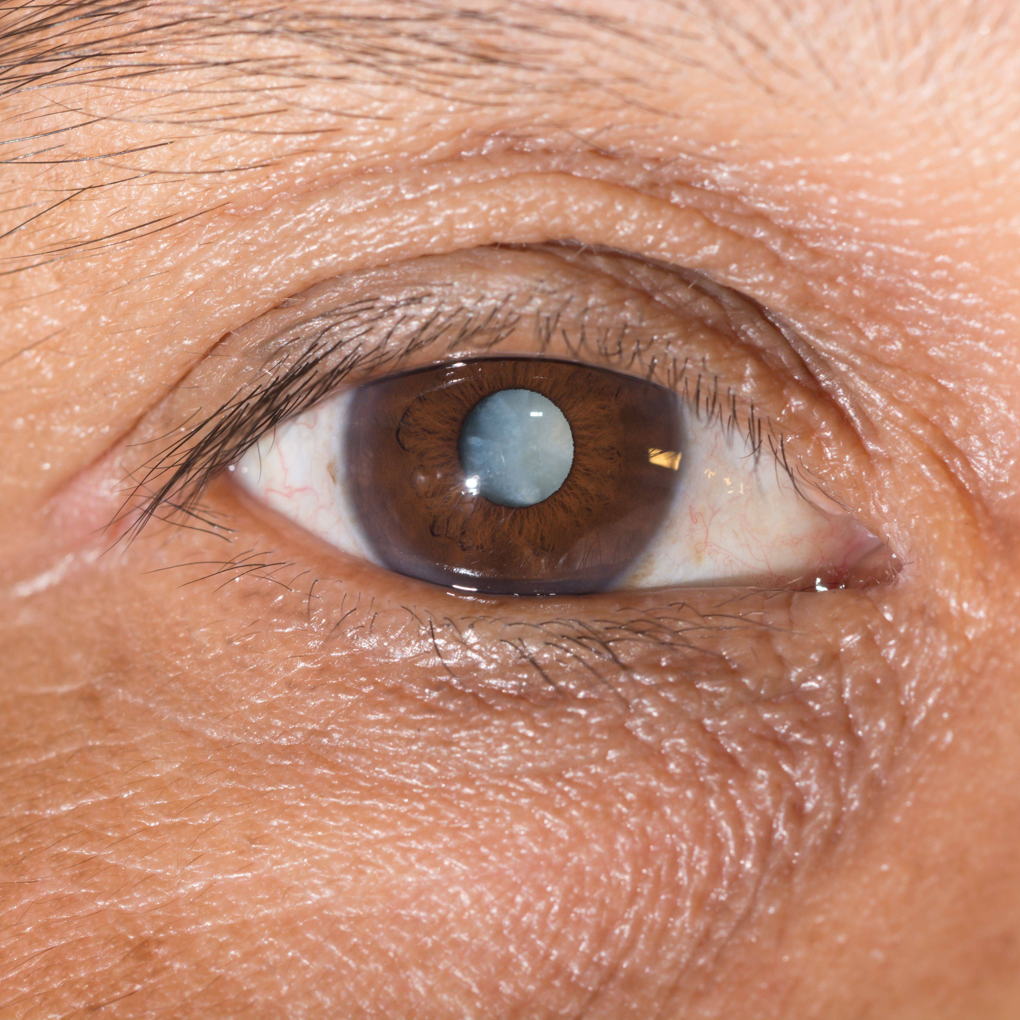 Белое пятно на глазу у человека - основные причины возникновения