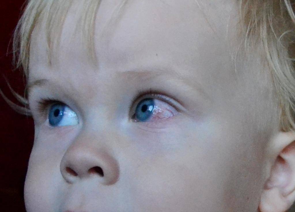 У ребенка слезятся глаза и насморк: причины, лечение