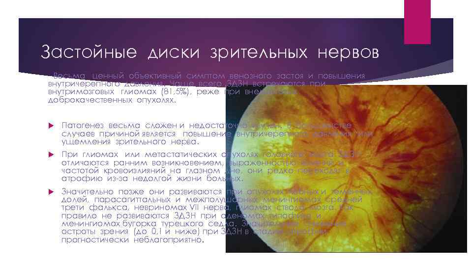 Застой диска зрительного нерва
