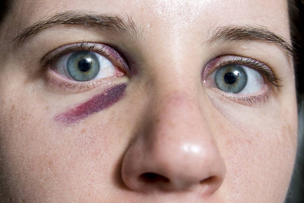 Синяки под глазами красные. красные синяки под глазами у ребенка: причину ищите в аллергии