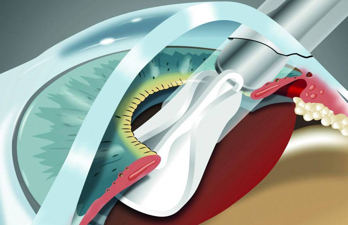 Какой хрусталик лучше при катаракте – советы офтальмолога