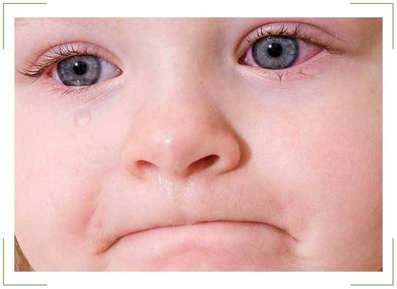 Покраснение вокруг глаз у ребенка и взрослого: причины и способы лечения в домашних условиях