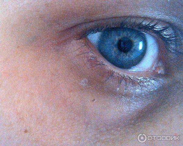 Темные круги под глазами: причины, болезни, как быстро убрать