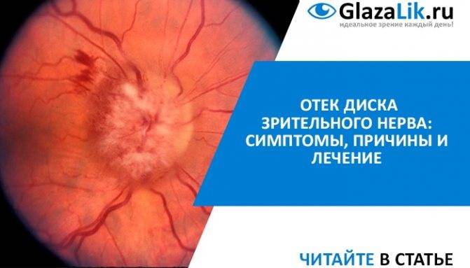 Воспаление зрительного нерва - причины, симптомы и лечение