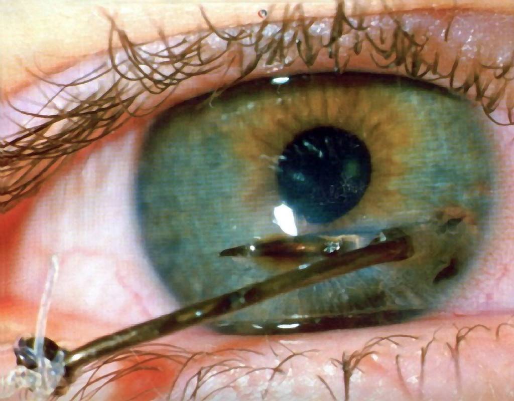 Ухудшение зрения на один глаз: причины, возможные заболевания, методы лечения - sammedic.ru