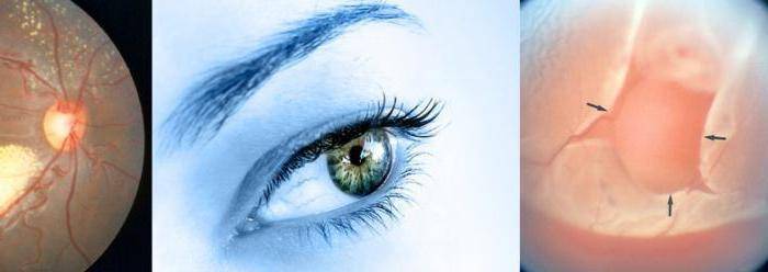 Операция при отслоении сетчатки глаза - проведение хирургического вмешательства, что нельзя делать после лечения лазером