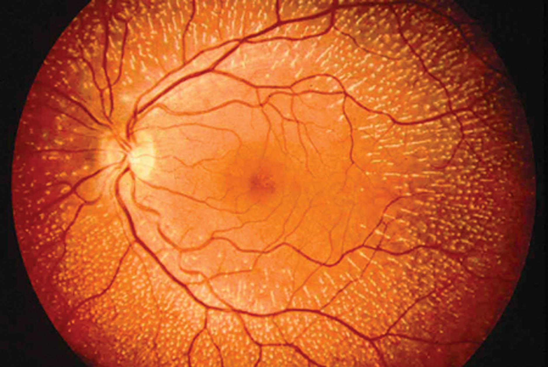 Фоновая ретинопатия: симптомы ретинальных сосудистых изменений
