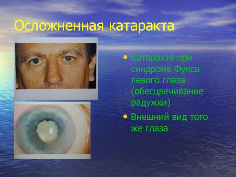 Пятно фукса: синдром гетерохромии глаз в офтальмологии