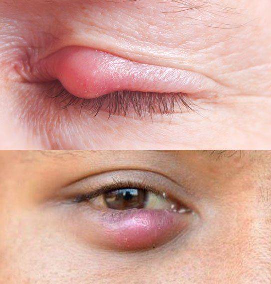 Ячмень на глазу –  симптомы, причины, как вылечить быстро