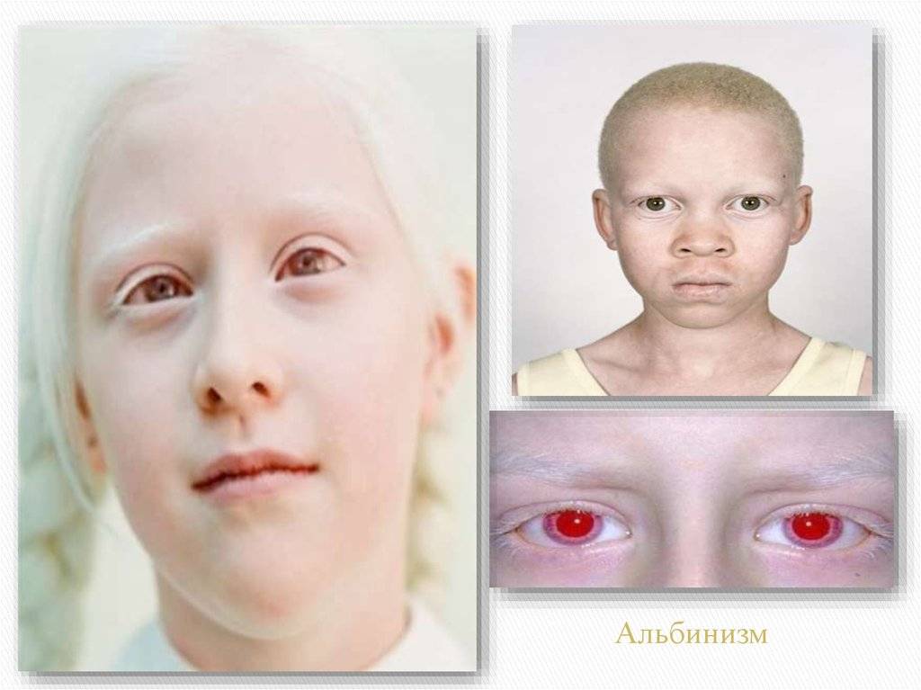Люди альбиносы с красными глазами: причины глазного альбинизма, классификация