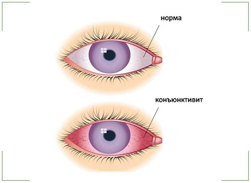Конъюнктивит глаз: виды заболевания и способы лечения у детей