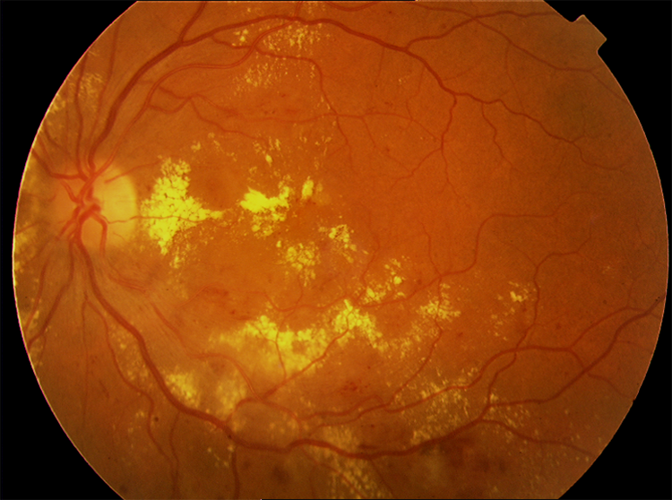 Диабетическая ретинопатия: виды, причины, симптомы, диагностика и лечение, последствия и меры профилактики + фото