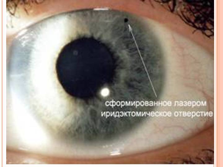 Лазерная иридотомия при глаукоме – особенности проведения операции — глаза эксперт