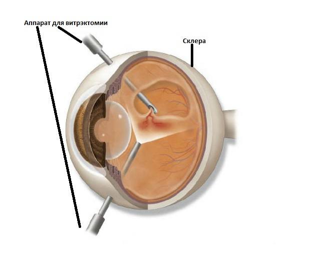 Витрэктомия -  хирургическое вмешательство на глазном яблоке