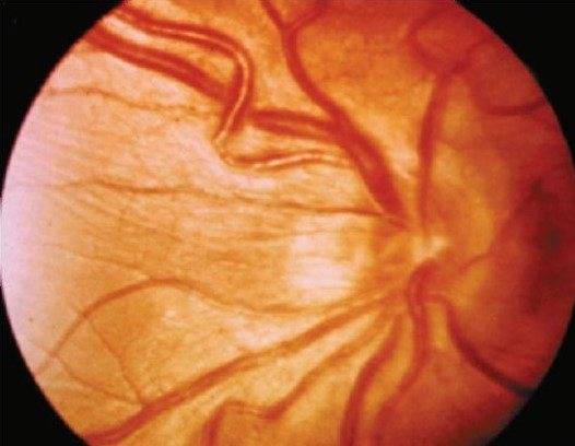 Ангиопатия сетчатки: что это такое, обоих глаз, сосудов, у взрослых, атеросклероз, лечение, симптомы, причины
