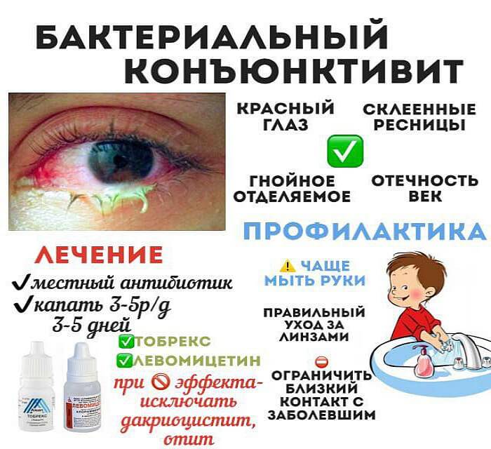 Комаровский о лечении бактериального конъюнктивита глаз у ребенка каплями