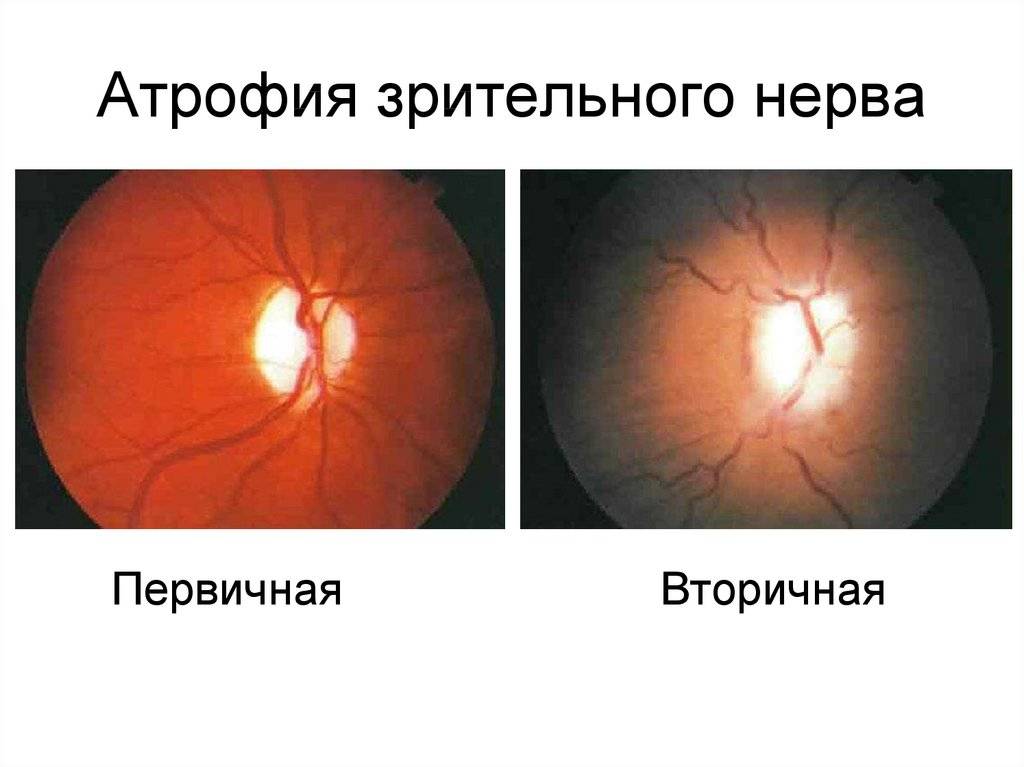 Заболевания зрительного нерва.