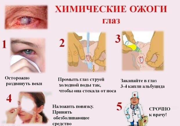Химический ожог глаз: первая помощь, лечение после наращивания ресниц, поражения роговицы известью, клеем, кислотой, степени и симптомы