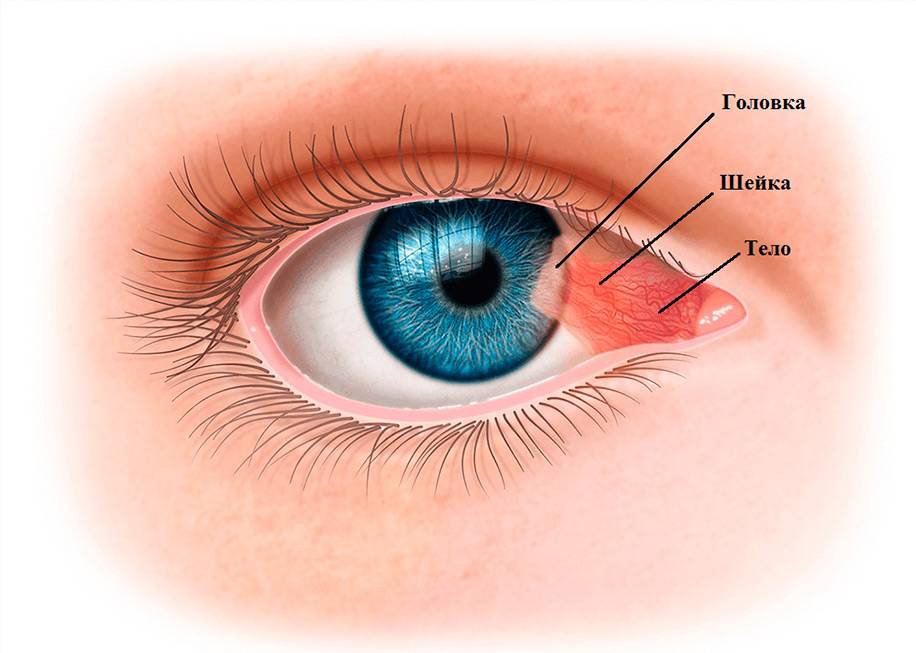 Пленка на глазах у человека: лечение и симптомы заболевания
