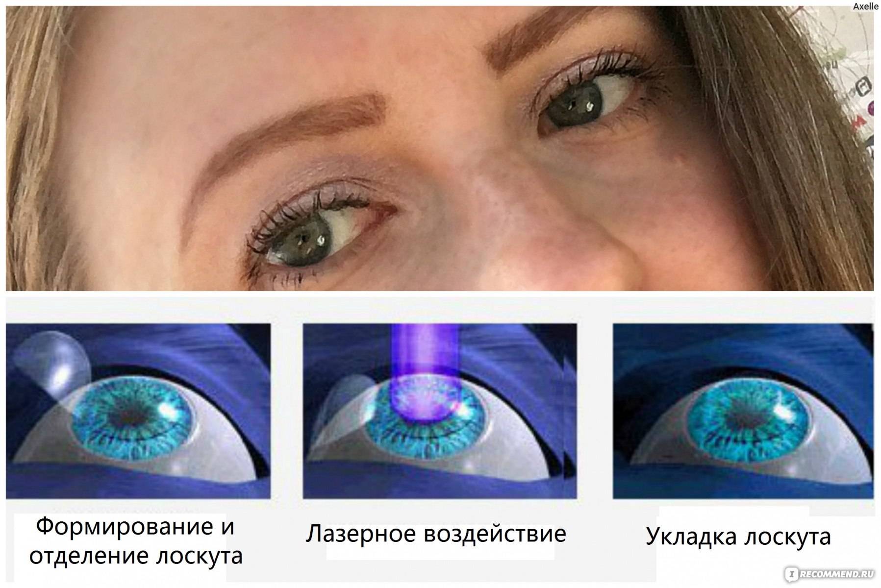 Цены на операцию лазерной коррекции зрения в клиниках москвы