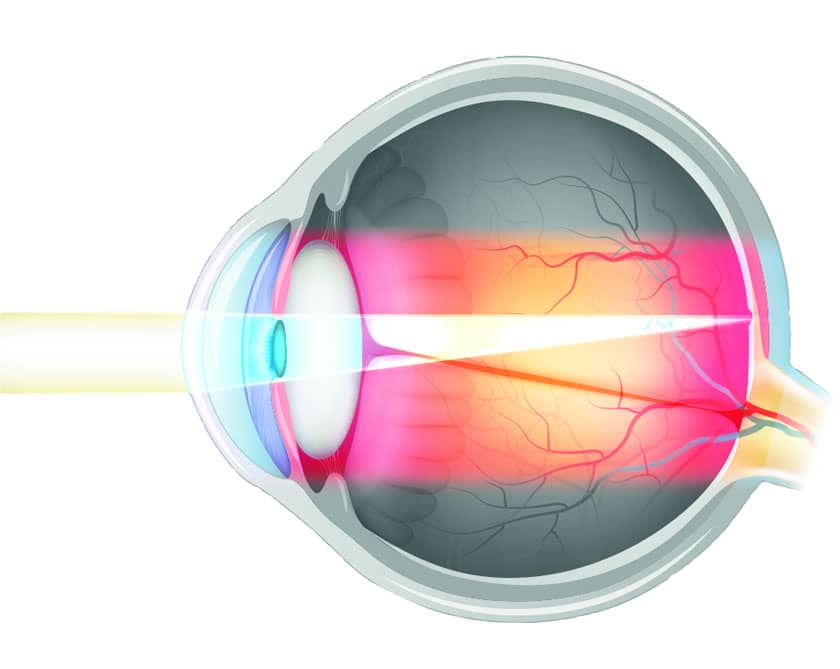 Нарушение аккомодации глаза - что это, лечение, причины и симптомы