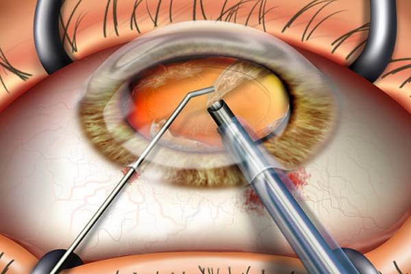Замена хрусталика глаза: показания, подбор хрусталика, подготовка к операции, капли и реабилитация