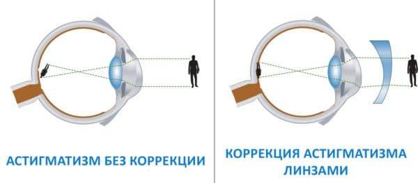 Линзы для дальнозоркости: бывают ли с плюсом, какие подходят при возрастной коррекции зрения, есть контактные плюсовые диоптрии