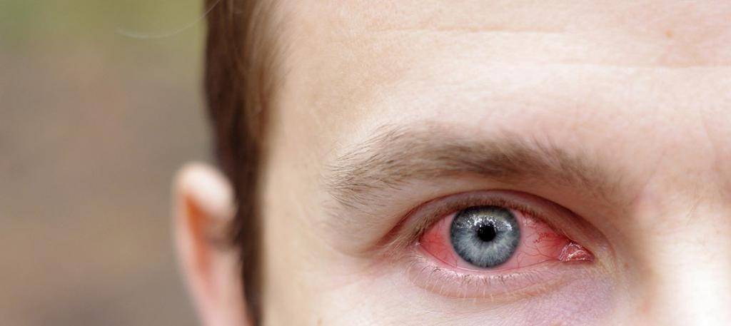 Как убрать кровоизлияние в глазу