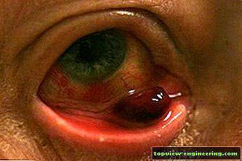 Мейбомит глаза или дисфункция мейбомиевых желез: причины, симптомы, лечение