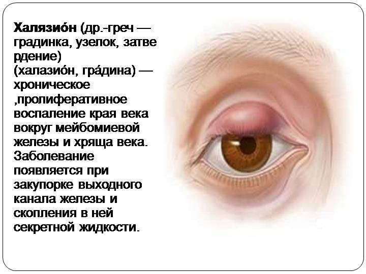 Ячмень на глазу: причины, проявления и лечение заболевания