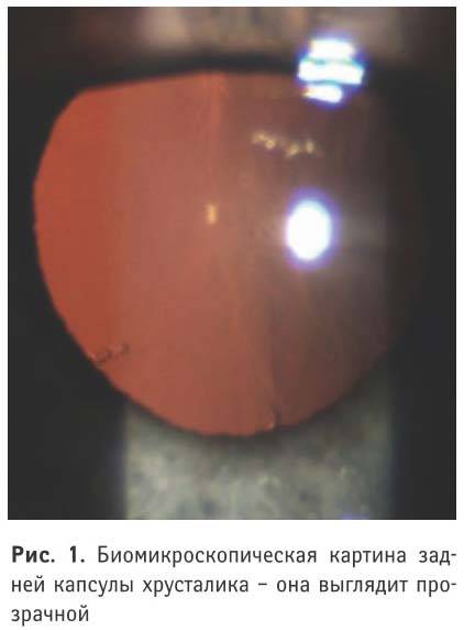 Лазерная дисцизия задней капсулы хрусталика при вторичной катаракте