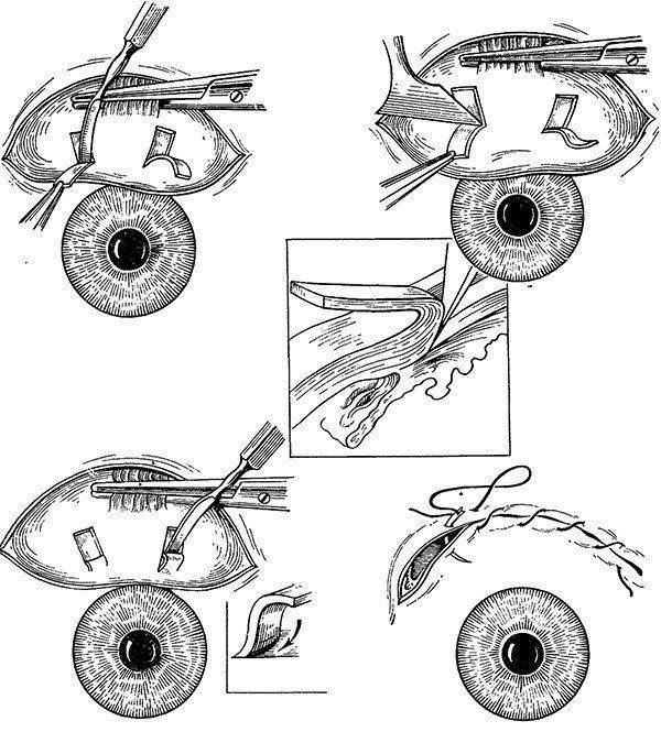 Лечение глаукомы лазером: плюсы и минусы операции