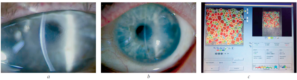 Пахиметрия роговицы глаза